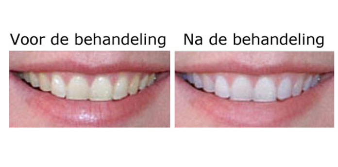 Day Dealers - Professioneel tanden bleken - 3x 20 minuten in Rotterdam